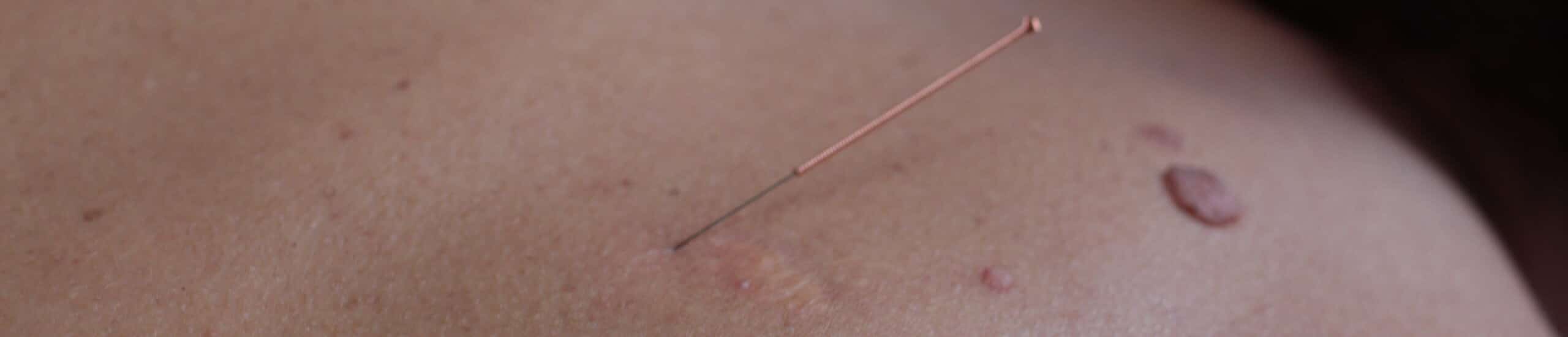 El després de la covid o de la inoculació de la vacuna